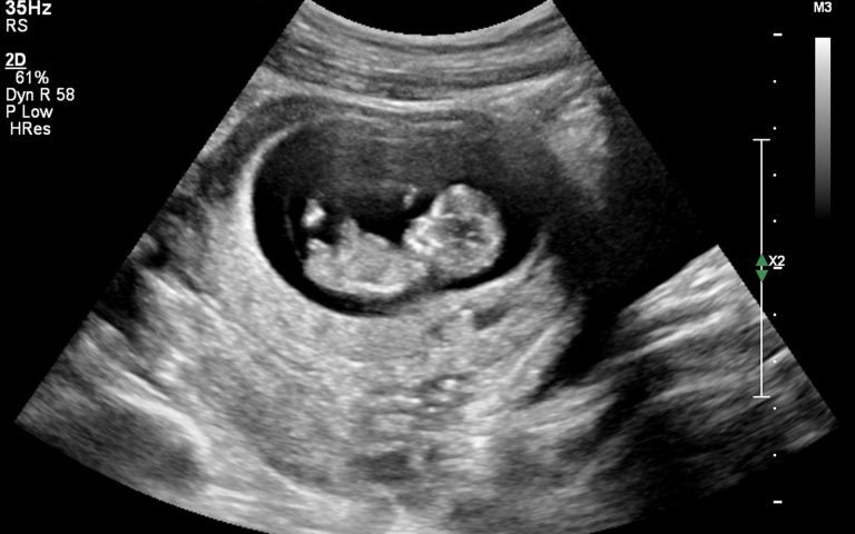 Ultrasound image